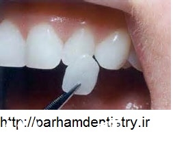 مصرف مواد غذایی ترش مزه و تاثیر آن روی دندان ها