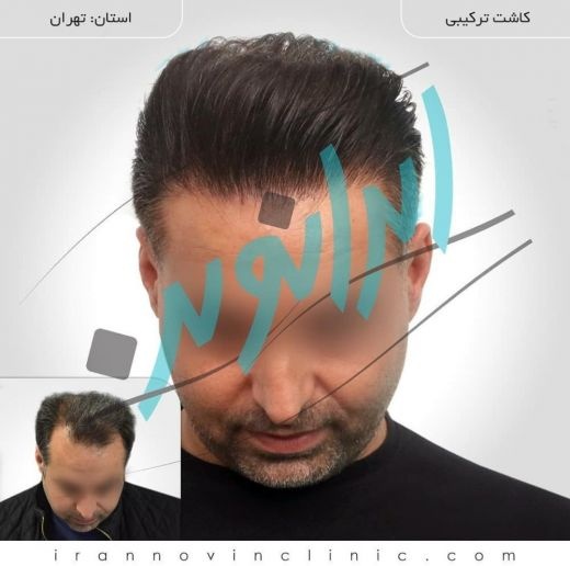 کاشت مو در ایران نوین تنها با دو و نیم میلیون