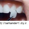 مصرف مواد غذایی ترش مزه و تاثیر آن روی دندان ها